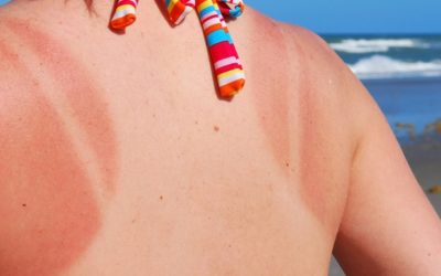 4 Natural Home Remedies to Ease the Pain of Sunburn