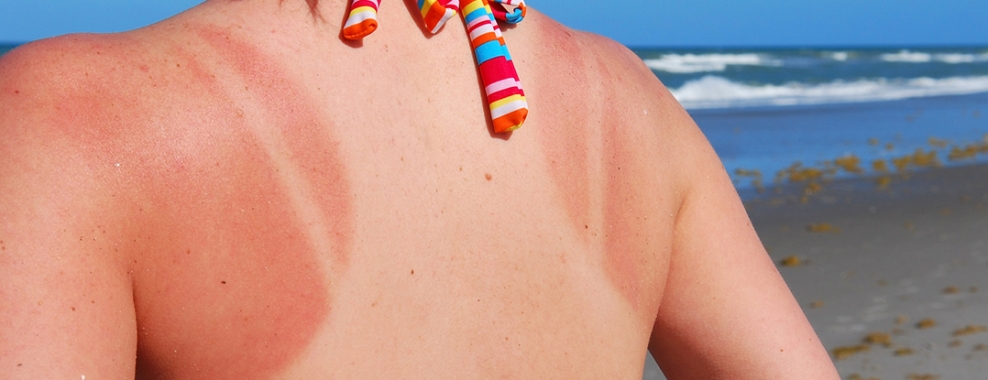 4 Natural Home Remedies to Ease the Pain of Sunburn